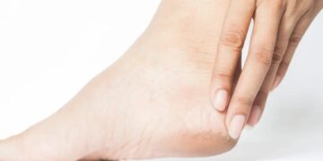 Tumit Pecah-Pecah Bukan Cuma Masalah Estetika—Yuk Kenali Penyebab dan Cara Mengatasinya!